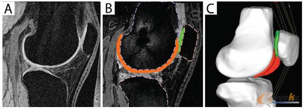 膝關節有限元模型