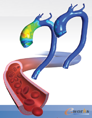 ANSYS仿真展現了未使用MFM(左)和使用MFM(右)的血管壁受力情況